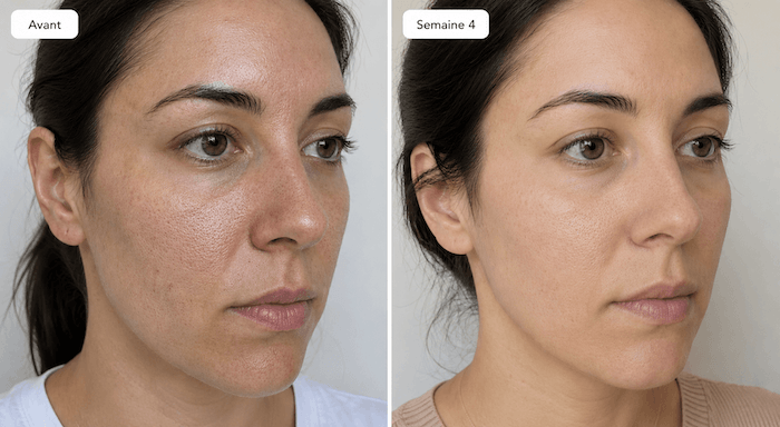 Laura M. - Pores dilatés, texture irrégulière